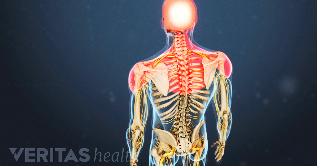 Cervical Osteoarthritis Symptoms